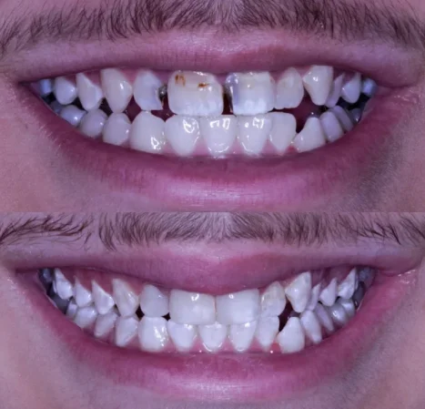 Cosmetic bonding gap teeth