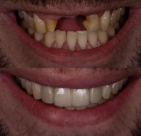 Cosmetic veneers and crowns smile