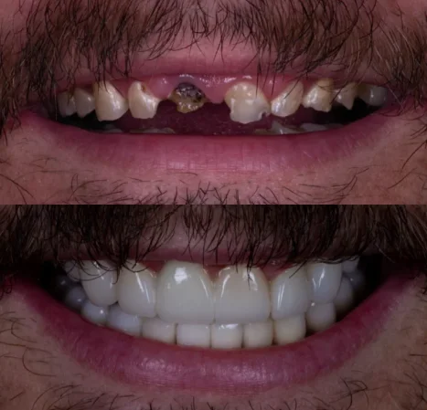 Full mouth reconstruction