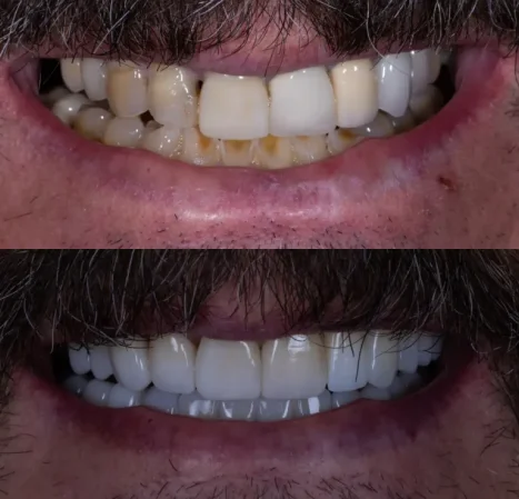 Full mouth rehabilitation smile transformation
