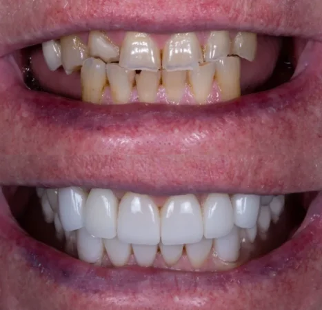 Full mouth rehabilitation
