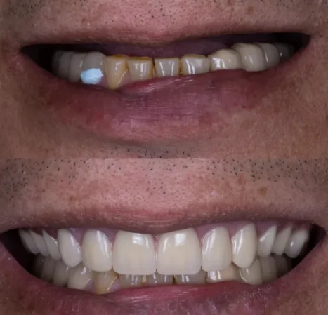 Smile makeover